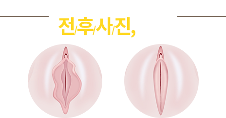 소음순, 질축소 전후사진/후기